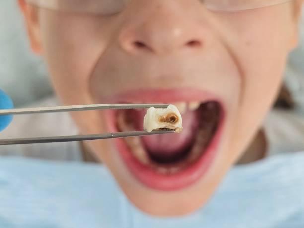 Best Knocked-Out Tooth (Avulsed Tooth) Treatment in Clearwater, FL